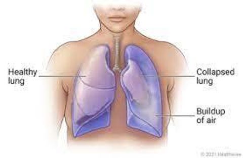 Guide to Understanding the Lack of Lung Space in Hyderabad: Causes, Facts, and Solutions
